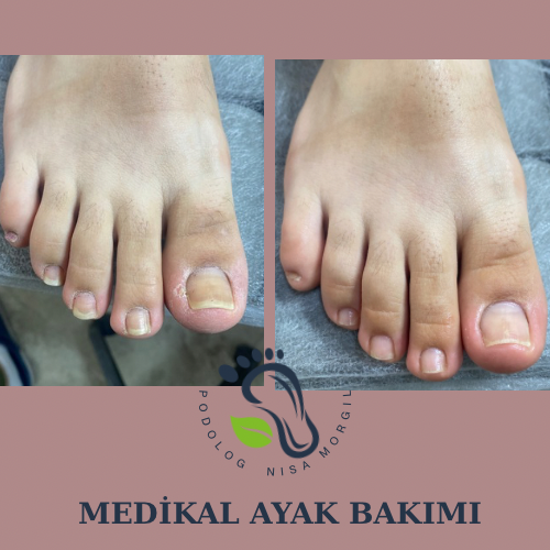 Medikal Ayak Bakımı
