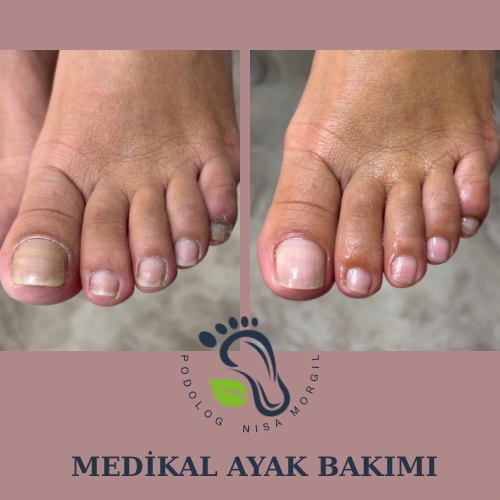 Medikal Ayak Bakımı
