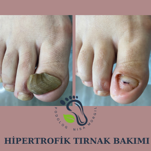 Kalınlaşmış Tırnak Bakımı