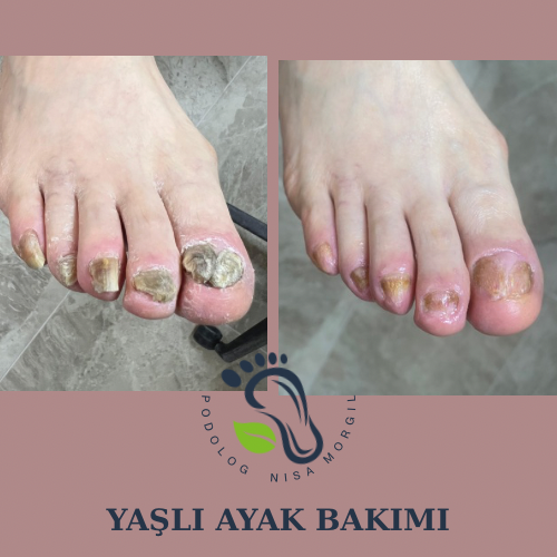 Yaşlı Ayak Bakımı
