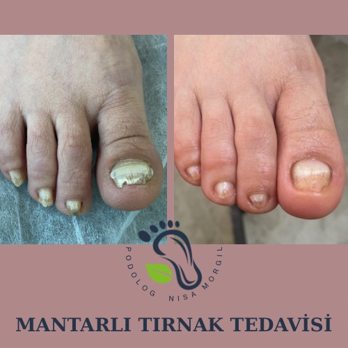 TIRNAK MANTARI TEDAVİSİ