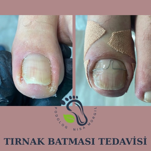 BATIK TIRNAK TEDAVİSİ ve ÖNLENMESİ